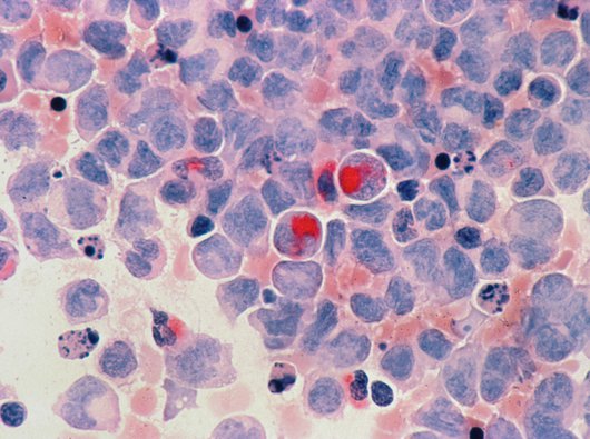 AML Cells - National Cancer Insitute.jpg