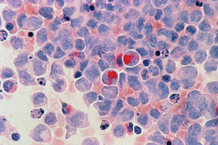 Acute myeloid leukaemia cells viewed through a microscope