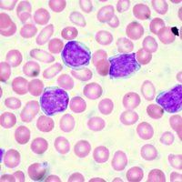 CLL cells
