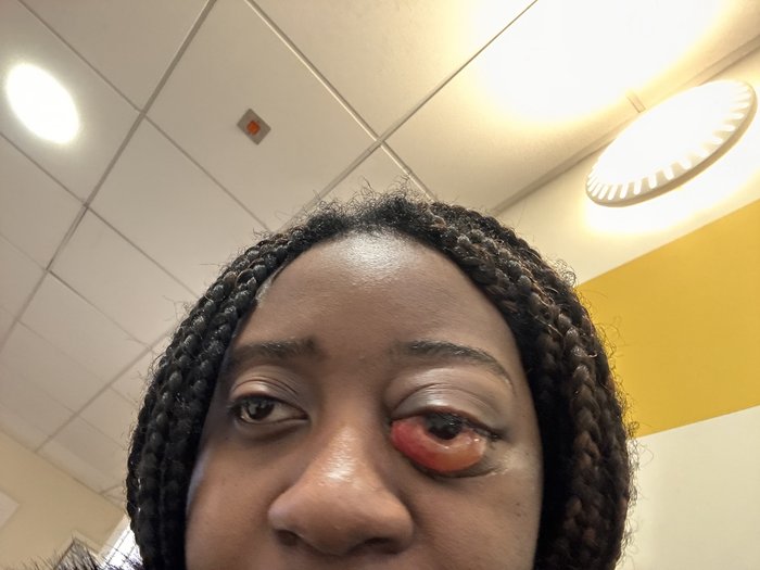 Close up of Mphango's eye, before her diagnosis of acute myeloid leukaemia, showing a visible tumour.