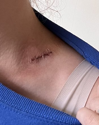 A small wound with stitches after a lymph node biopsy.