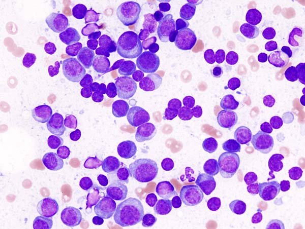 myeloma cells under a microscope