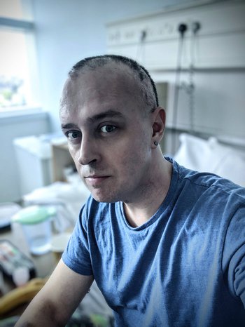 A picture of Scott during his treatment for myeloma, showing the side effect of hair loss