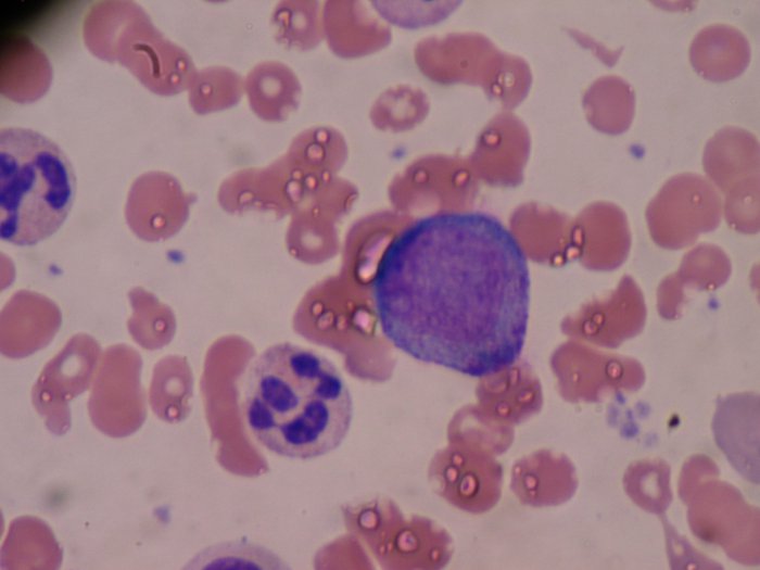 Promyelocytic leukaemia cells under a microscope.