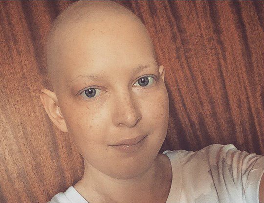 A young woman who has lost her hair from cancer treatment.